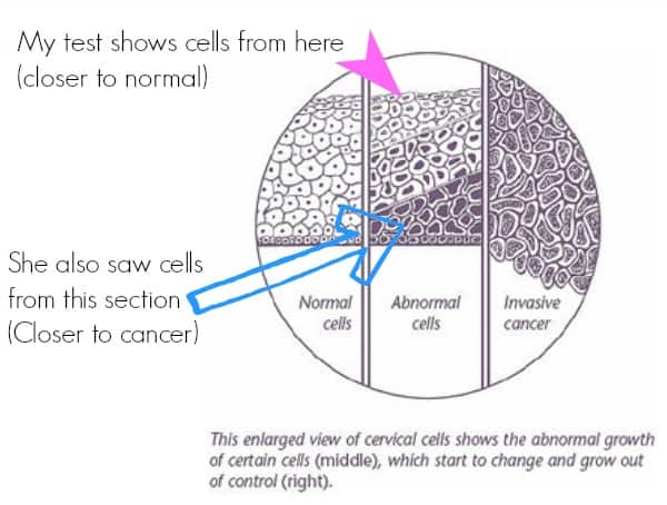 Graph showing the different types of cervical cancer cells.