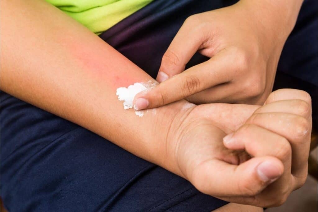 A person applies a white cream to a red, irritated area on their forearm using their finger, exploring alternative uses for baking soda in soothing skin discomfort.
