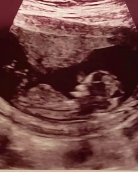An ultrasound of an unborn baby.