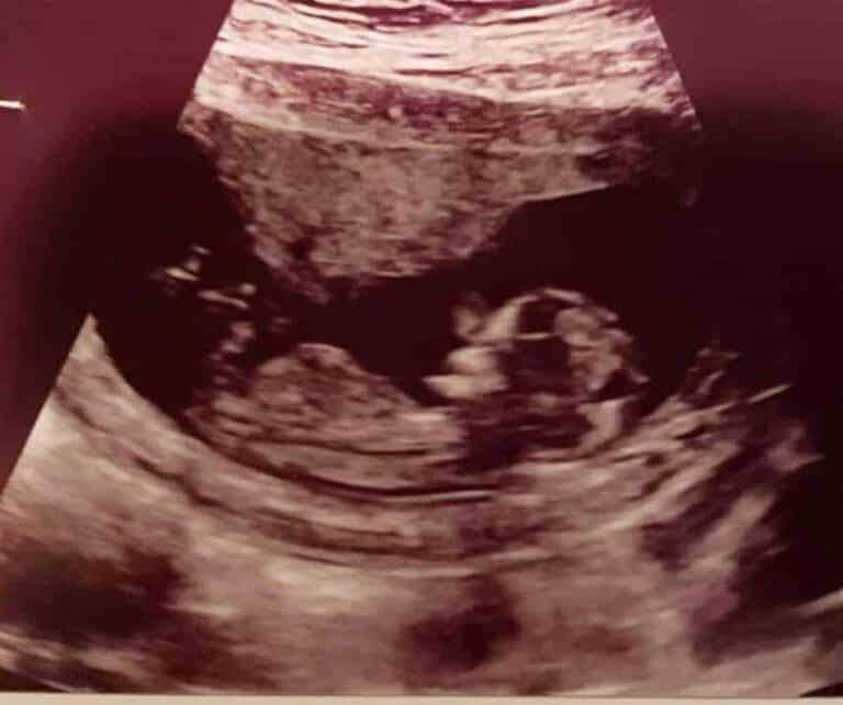 An ultrasound of an unborn baby.